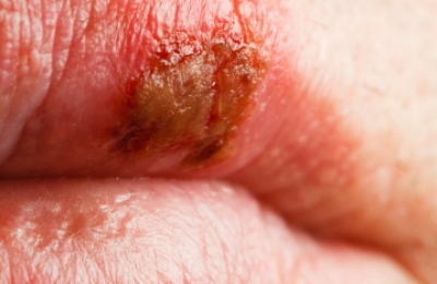 HSV-1 Fever Blisters Cold Sores Herpes Treatment Miami Dermatology