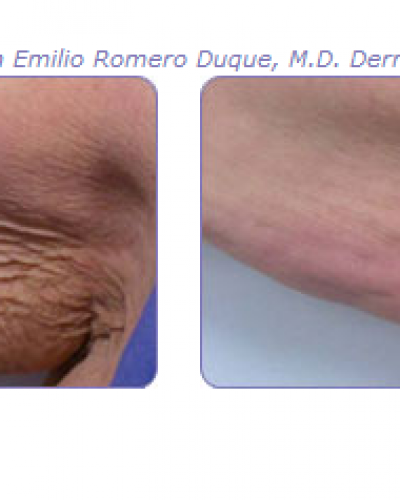Miami Center for Dermatology Miami Tattoo Removal - Miami Skin Care ...