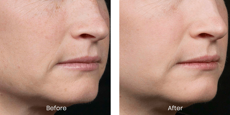 Before and after photo of white woman receiving fraxel laser treatment