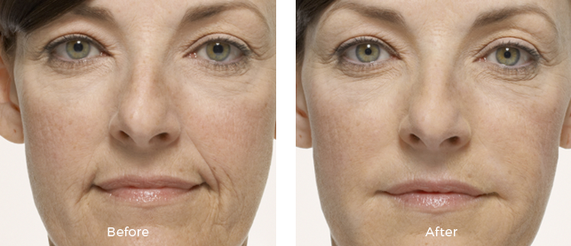 woman before and after juvederm treatment