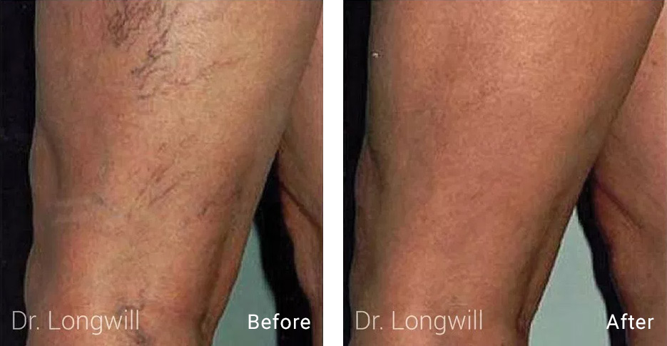Before and after of patient treatment of SCLEROTHERAPY