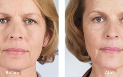 before and after female patient with sculptra