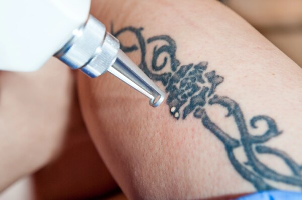 Tattoo Removal