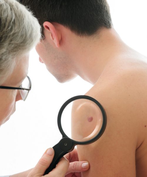 Doctor checking for Skin Neoplasms