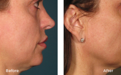 Before and after woman ultherapy