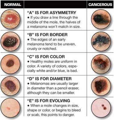 Symptoms of Skin Cancer