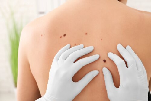 Malignant Melanoma Treatment Near Coral Gables
