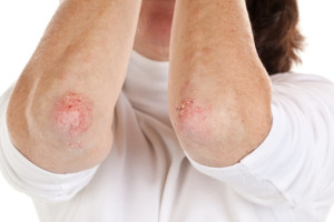 Psoriasis Treatment Near Country Walk