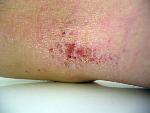 Eczema Treatment Miami
