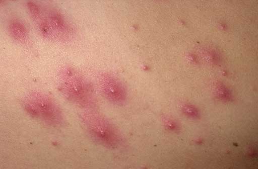Folliculitis on skin