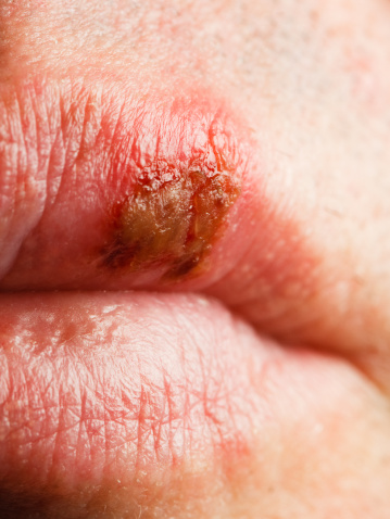HSV-1 Fever Blisters Cold Sores Herpes Treatment Miami Dermatology