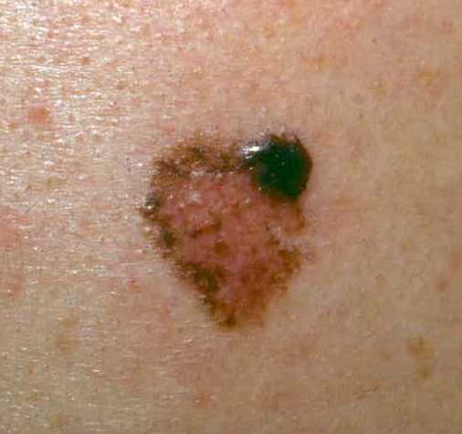 Melanoma Skin Cancer