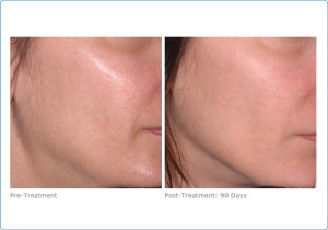 ultherapy_lower_face_2-9