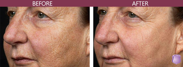 Skin Resurfacing Treatments in Miami , skin resurfacing treatment