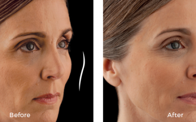 woman before and after juvederm voluma treatment