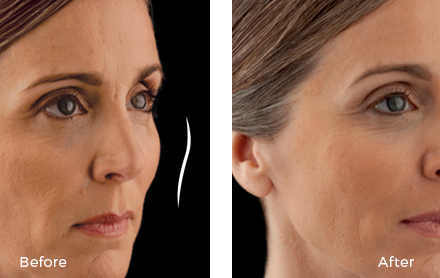 woman before and after juvederm voluma treatment