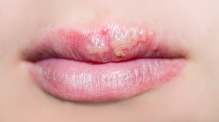 Lips with Herpes