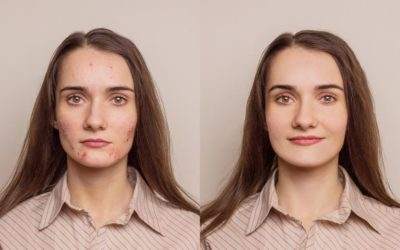 before and after for acne Treatment in Miami