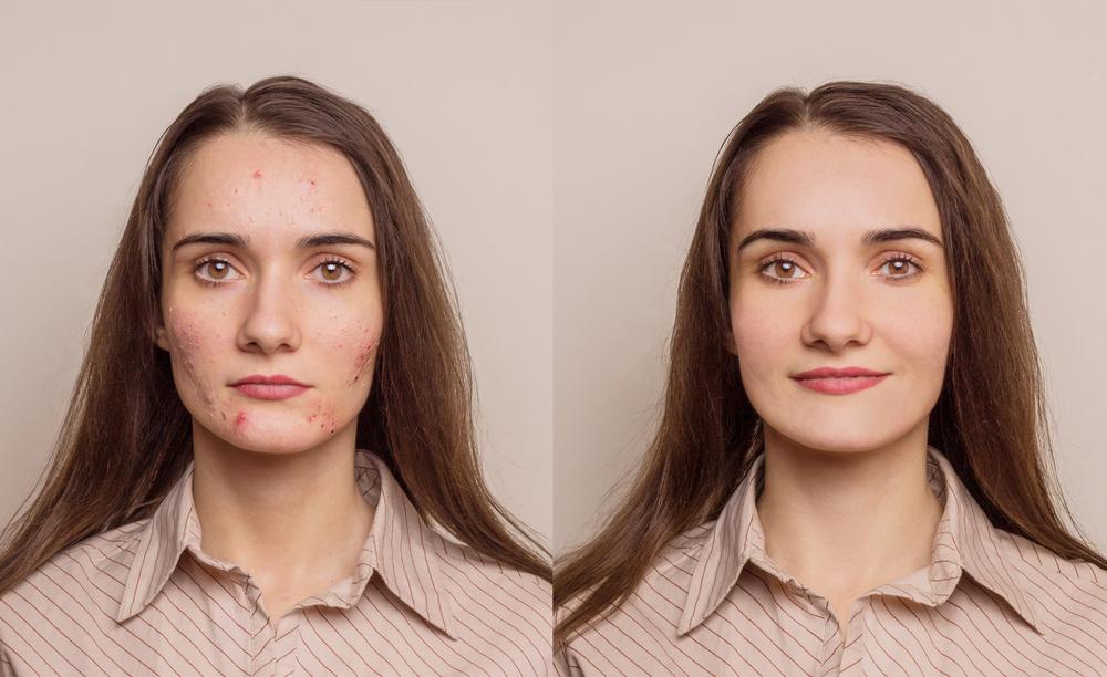 before and after for acne Treatment in Miami