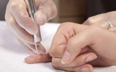 Patient getting Wart Removal in Miami