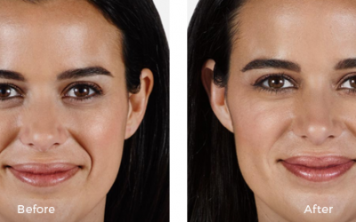 Before and after juvederm