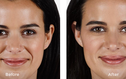 Before and after juvederm