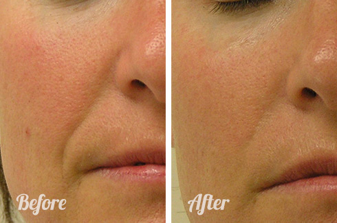 Before and after hydrafacial
