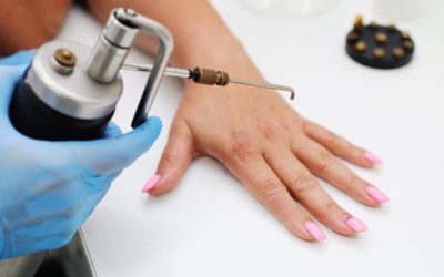 Woman with pink nails getting a wart treatment