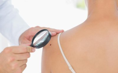 doctor checking for skin cancer
