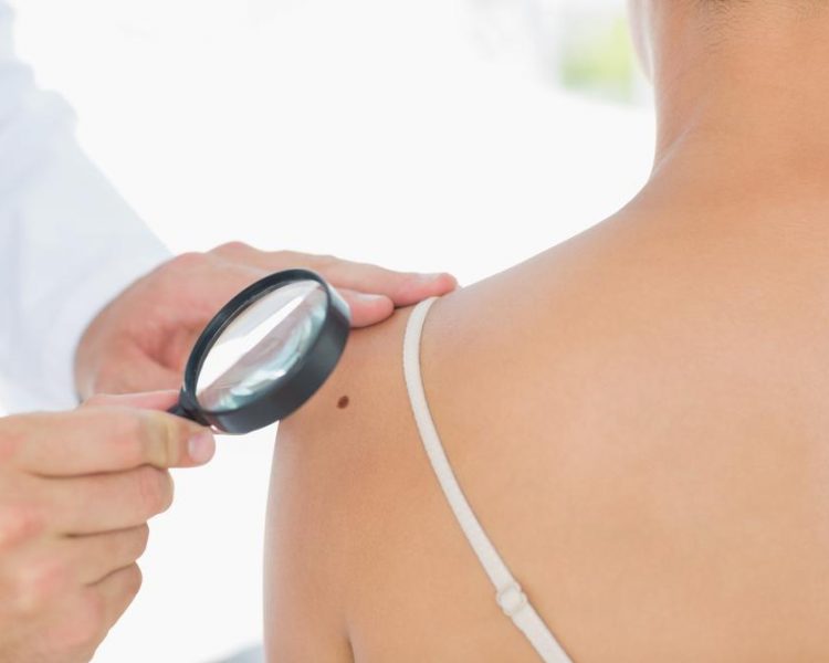 doctor checking for skin cancer