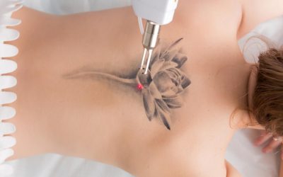 patient getting laser tattoo removal