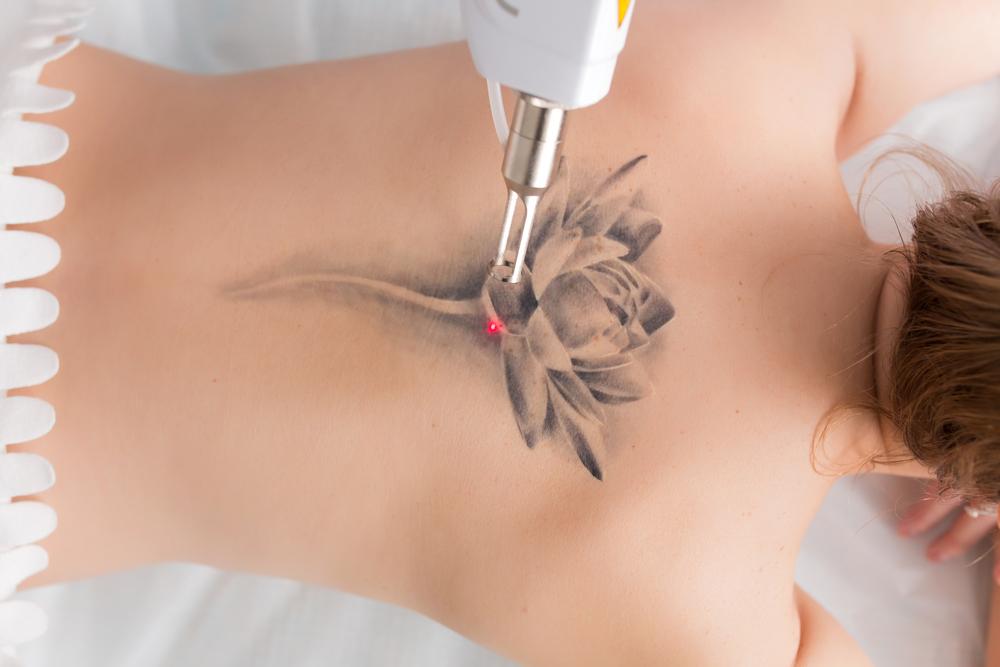 patient getting laser tattoo removal
