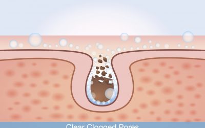 a diagram of dirt trapped in pores