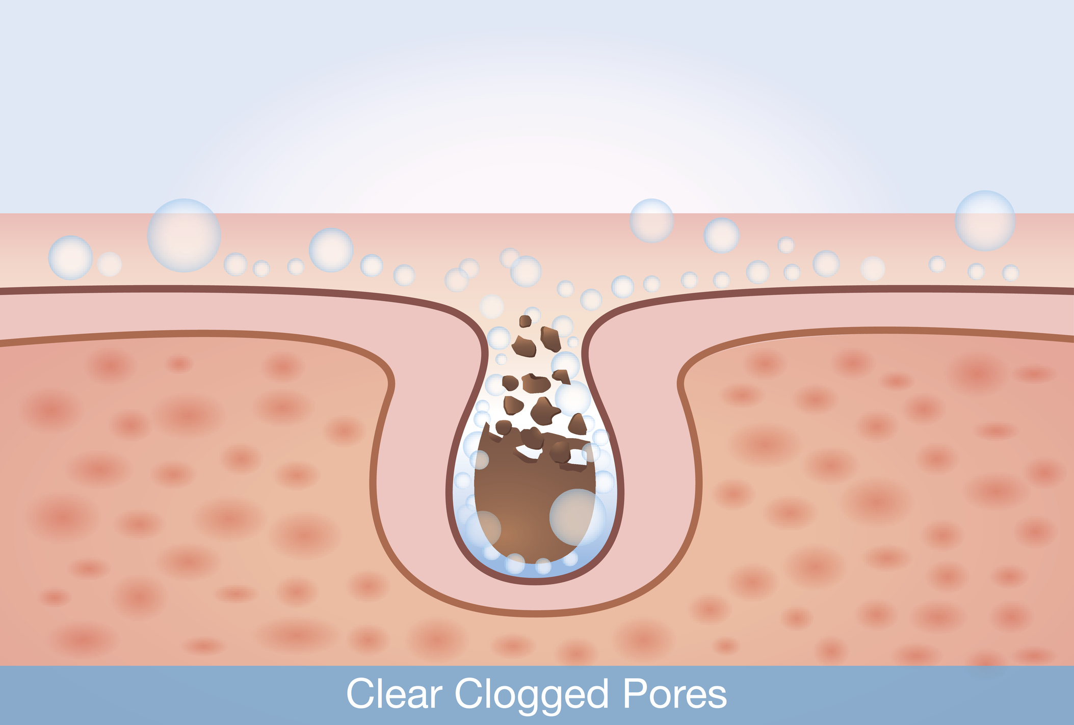 a diagram of dirt trapped in pores