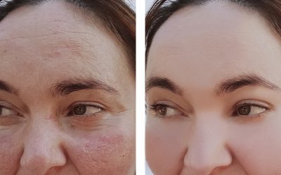 woman wrinkles face before and after procedures