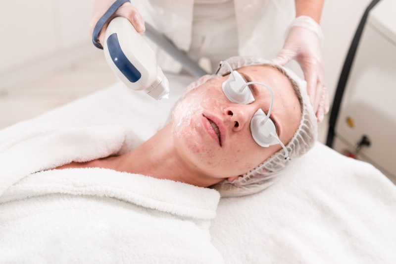 Woman with cystic acne receiving laser treatment.