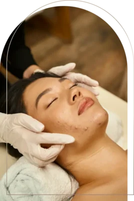 Acne Facial
