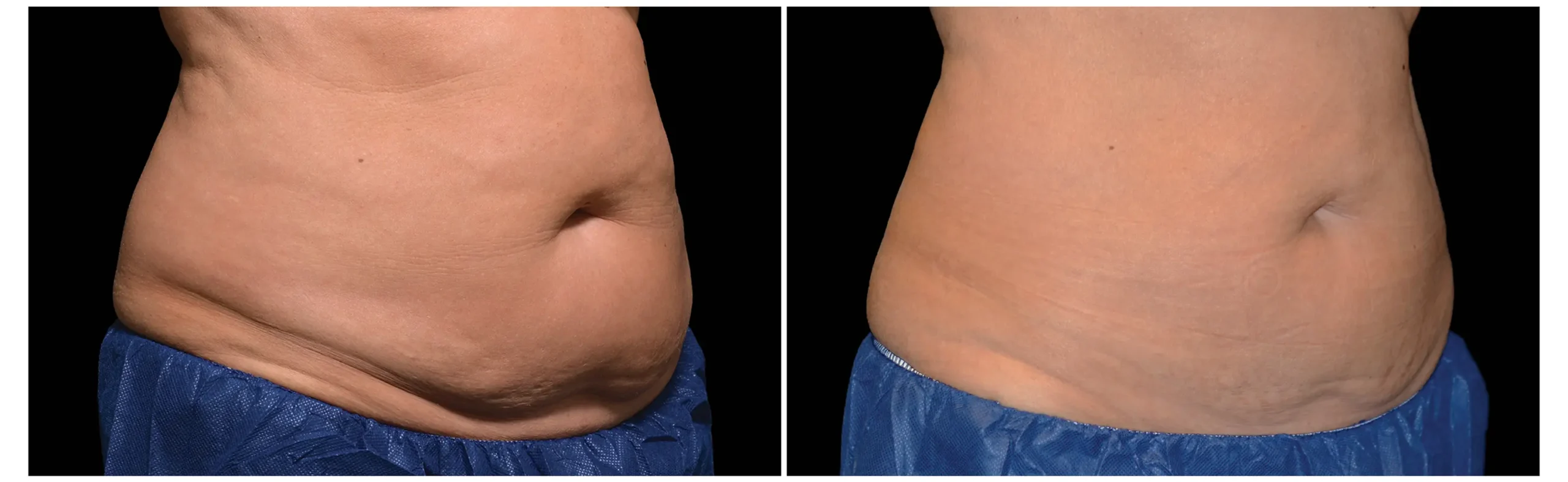 Befor & After Image 1 Before and after results of CoolSculpting treatment in Miami, showing noticeable belly fat reduction.