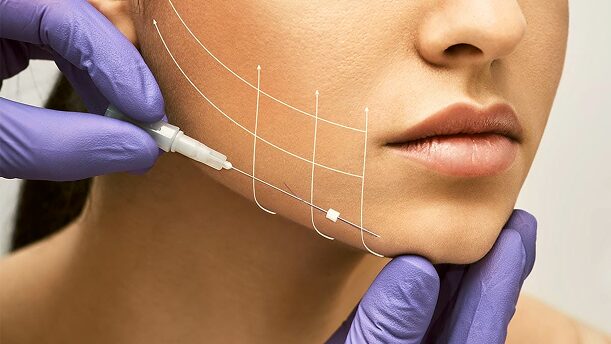 Woman getting PDO thread lift on jawline