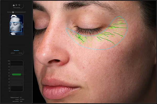 Advanced Wrinkle Analysis Technology in Dermatology Woman's face close-up showing a digital analysis of wrinkles around the eye area.