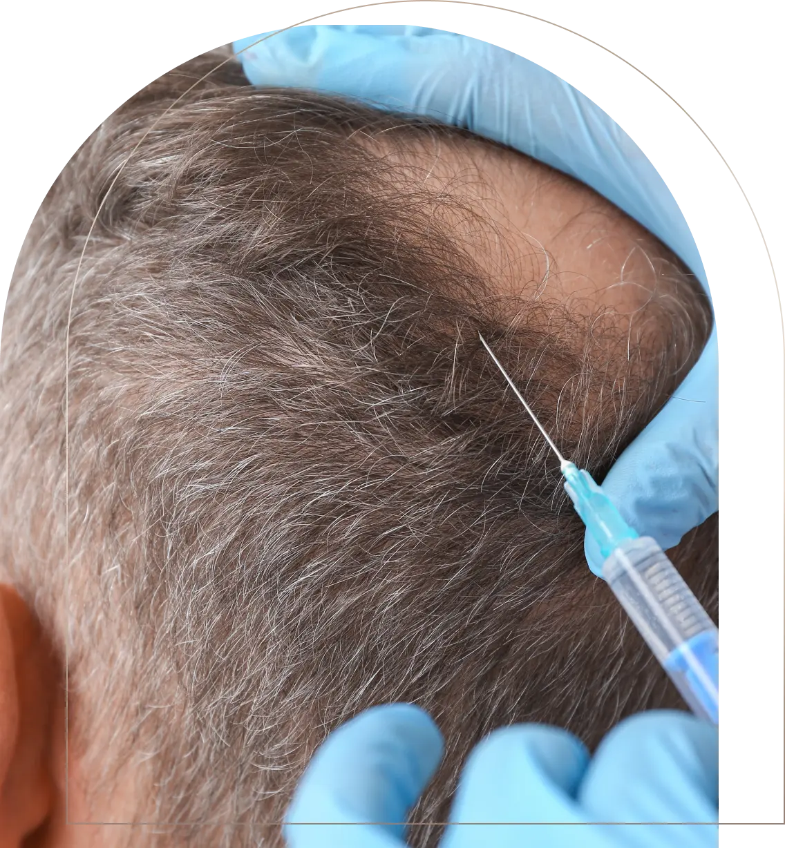 Injection for hair loss treatment on scalp