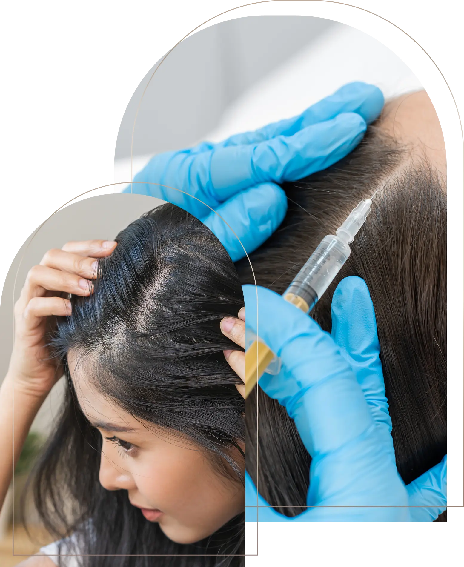 Scalp injection treatment for hair loss