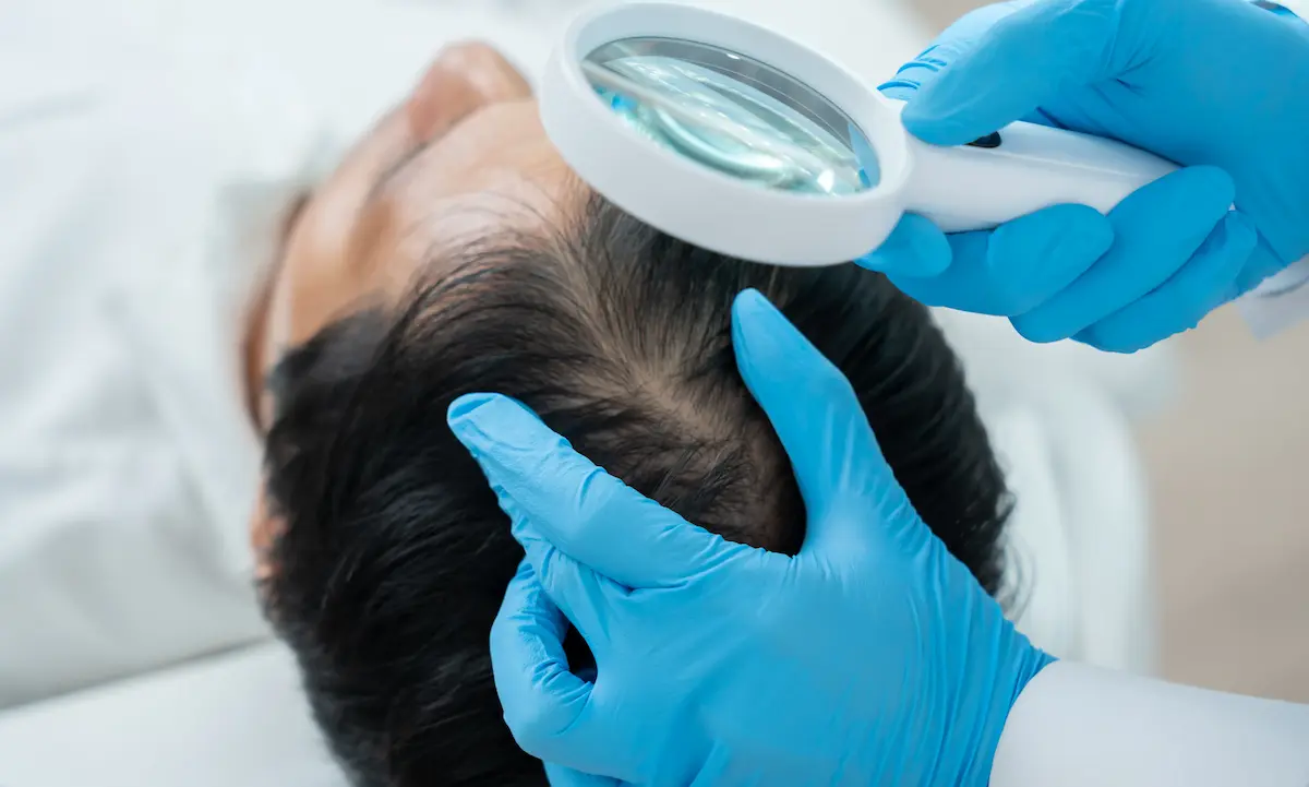 Doctor examining thinning scalp with magnifying glass
